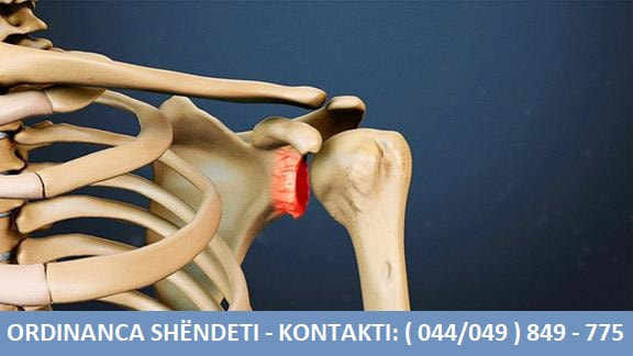 Osteoartriti i Shpatullave - Simptomat dhe Shkaqet